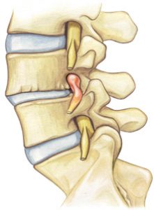 spinal stenosis